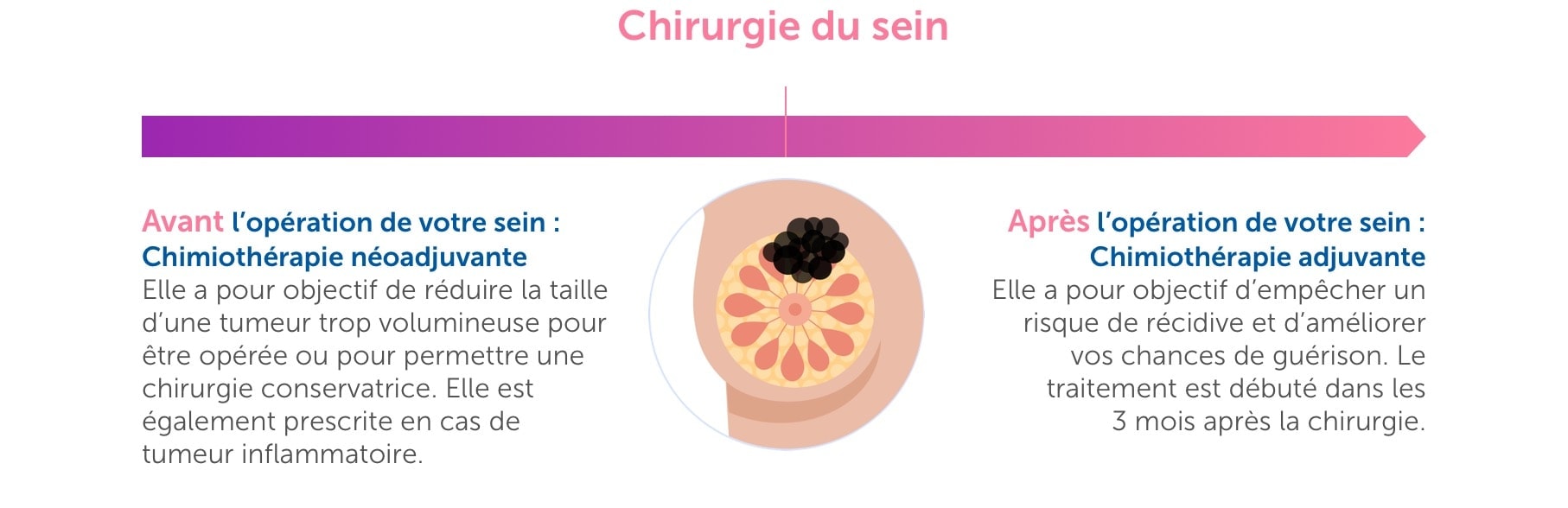 Chirurgie du sein Schéma de Chirurgie du sein
