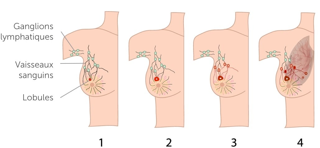 Le trajet de la tumeur Schéma du trajet de la tumeur